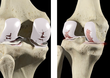 Uma promessa que já tem história: o gel alemão e a corrida pela regeneração da cartilagem